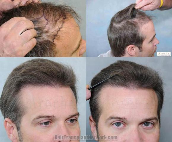 Hair transplantation surgery before and after images