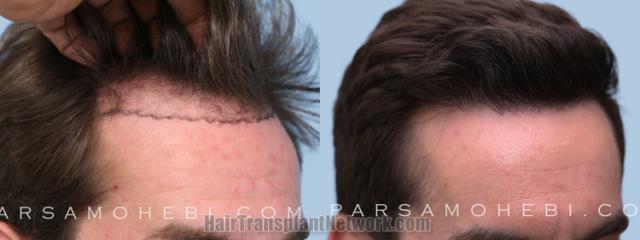 Hair transplantation surgery before and after images