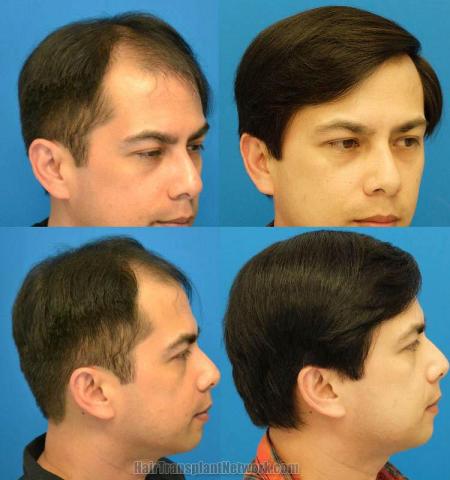 Hair replacement surgery before and after images