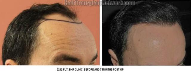 Hair transplantation surgery before and after pictures