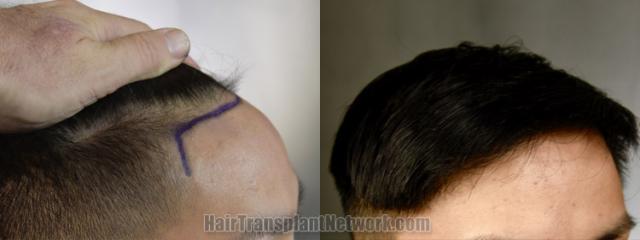 Hair transplantation surgery before and after images