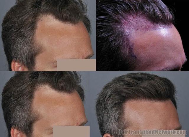 Hair restoration procedure before and after pictures