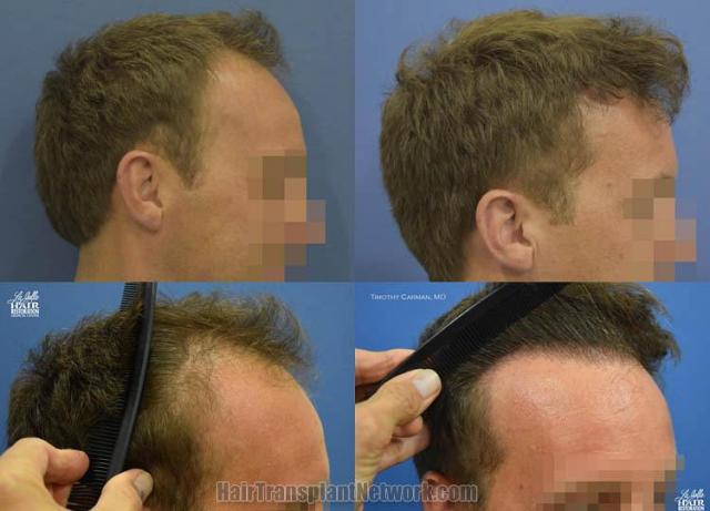 Hair transplantation surgery before and after images