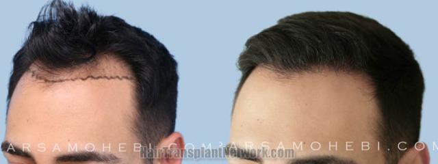 Hair transplantation surgery before and after images