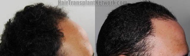 Hair transplantation procedure before and after results