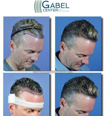 Hair transplantation surgery before and after images