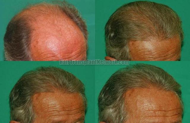 Hair restoration procedure before and after results