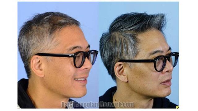 Hair transplantation surgery before and after images