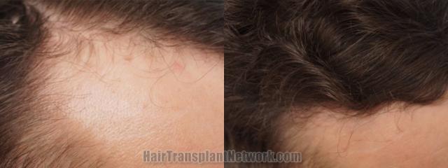 Hair transplantation surgery before and after images