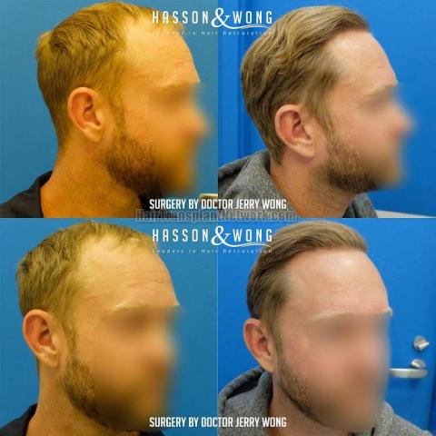 Hair restoration procedure before and after result images