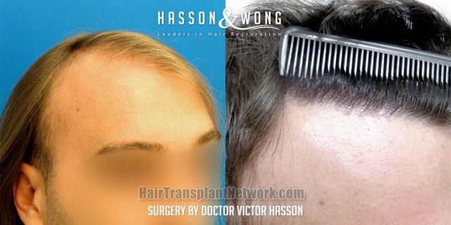 Hair restoration procedure before and after result images