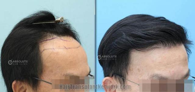 Hair transplantation procedure before and after results