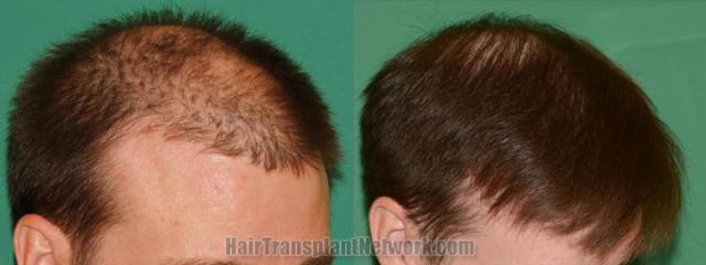 Hair restoration procedure before and after pictures