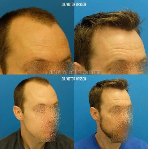 Hair restoration surgery before and after photos