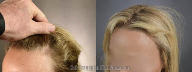 Hair transplantation surgery before and after images