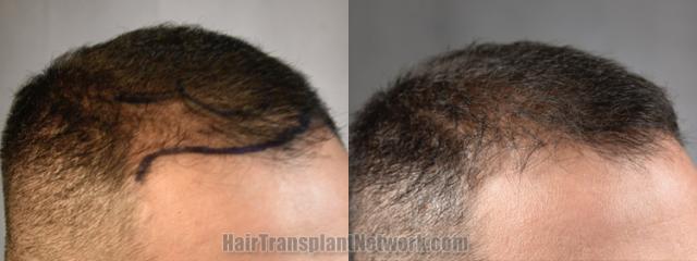 Hair transplantation surgery before and after images