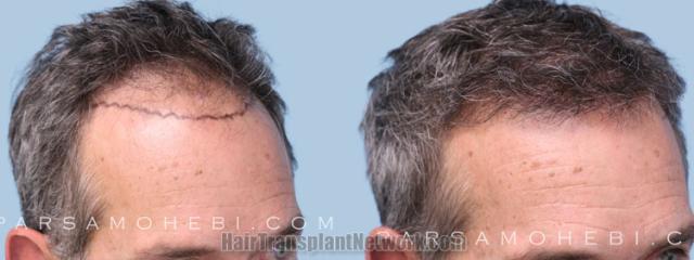 Hair transplantation surgery before and after images