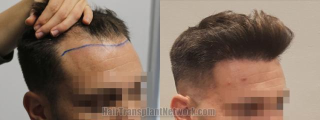 Hair transplantation surgery before and after images