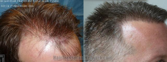 Hair transplantation surgery before and after images