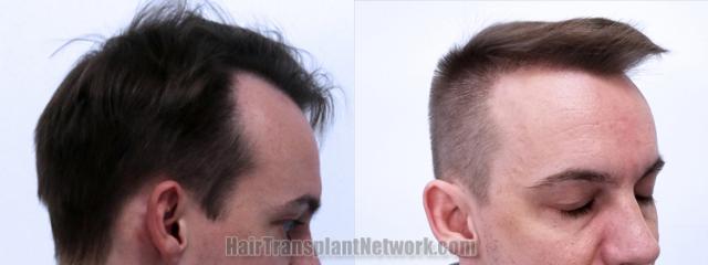 Hair transplantation surgery before and after images