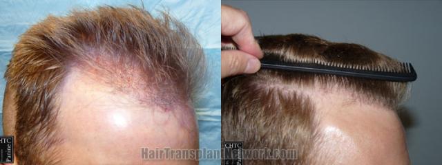 Hair transplantation surgery before and after images