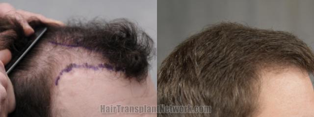 Hair transplantation surgery before and after images