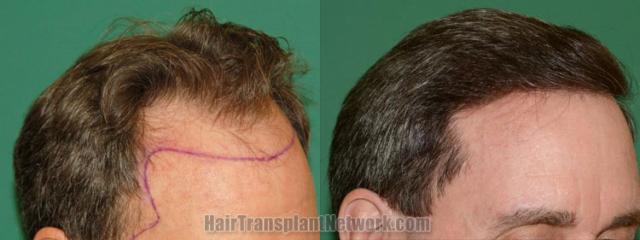 Hair transplantation surgery before and after images