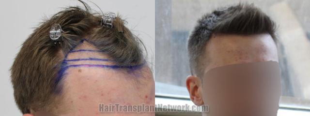 Hair transplantation surgery before and after images