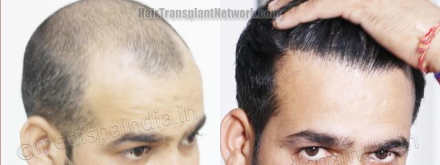 Hair transplantation surgery before and after images