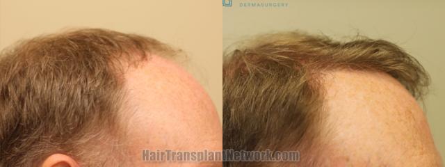 Hair transplantation surgery before and after images