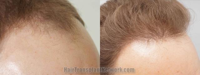 Hair transplantation surgery before and after images