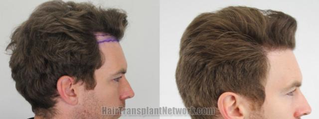 Hair transplantation surgery before and after images