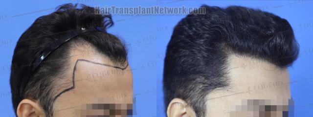 Hair transplantation surgery before and after images