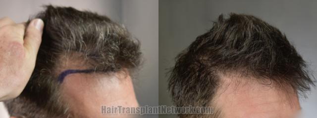 Hair transplantation surgery before and after images