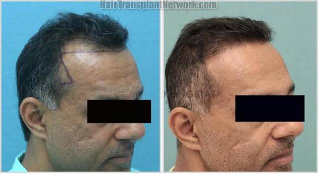 Hair transplantation surgery before and after images