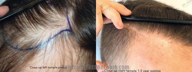 Hair transplantation surgery before and after images