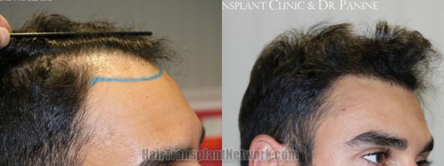 Hair transplantation surgery before and after images