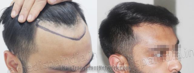 Hair transplantation surgery before and after images