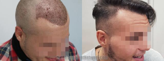 Hair transplantation surgery before and after images