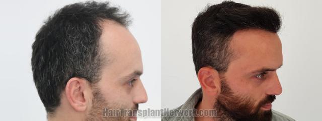 Hair transplantation surgery before and after images