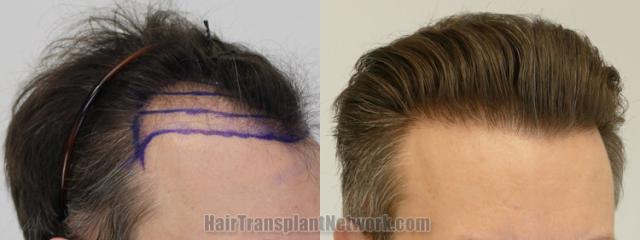 Hair transplantation surgery before and after images