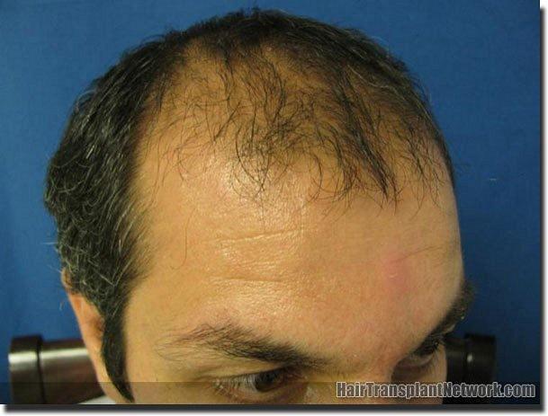 Hair restoration procedure results