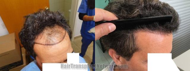 Hair transplantation surgery before and after images