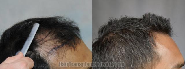 Hair transplantation surgery before and after images