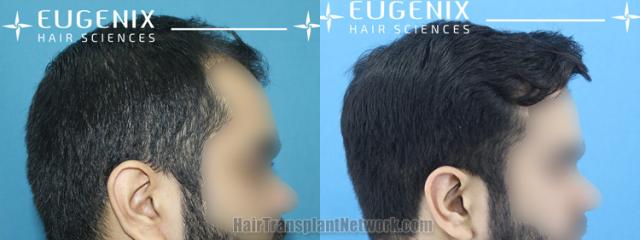 Hair transplantation surgery before and after images