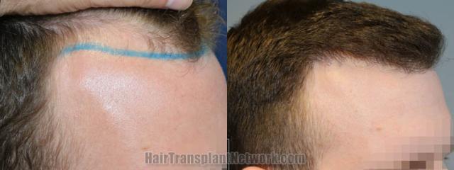 Hair transplantation surgery before and after images