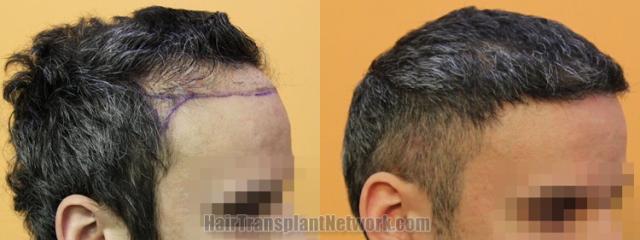 Hair transplantation surgery before and after images