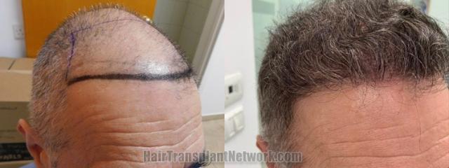 Hair transplantation surgery before and after images