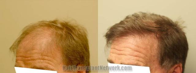 Hair transplantation surgery before and after images