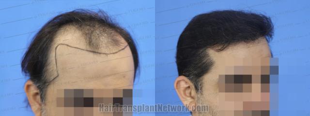 Hair transplantation surgery before and after images